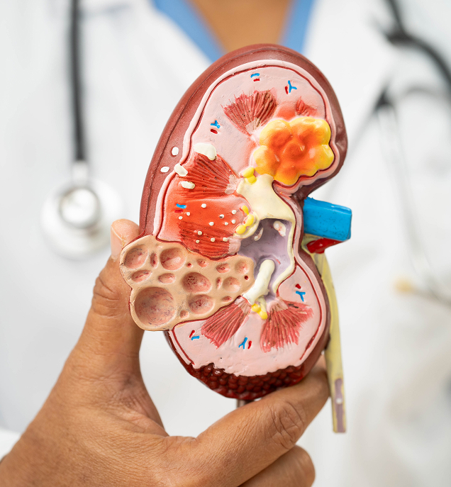 Tratamento preciso para aliviar a dor e remover a pedra com segurança