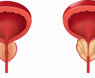 cirurgia de próstata laparoscópica: Técnica, Vantagens e Resultados - Guia Completo 2025