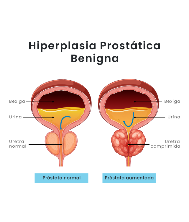 Tecnologia a laser para tratar a próstata aumentada com mais eficiência